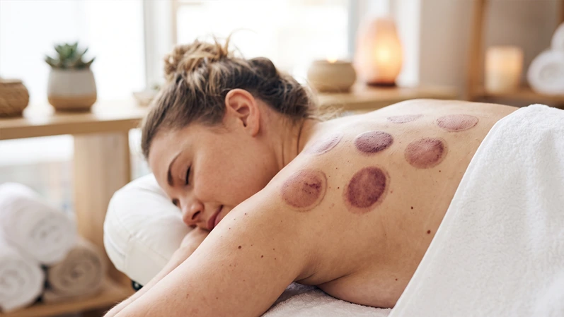 Close-up of cupping marks on a client's shoulder and upper back, calm spa setting, no text in image